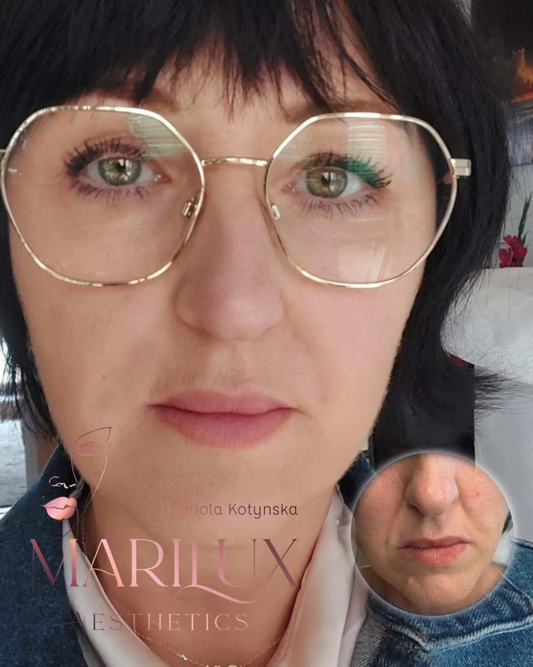 Lip filler result 4 — perfect lip volume